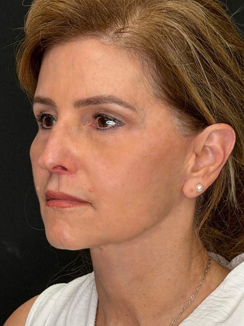 Deep Plane Facelift 60s Before & After Gallery - Patient 246083 - Image 8