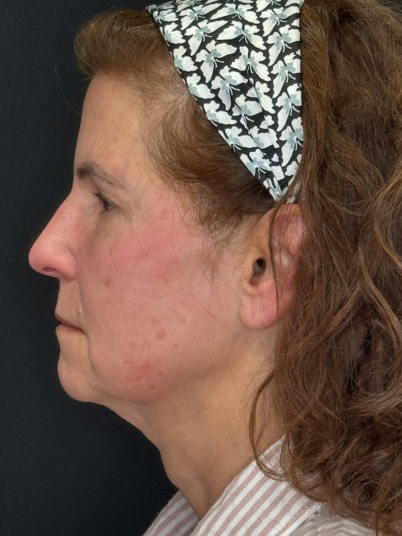Deep Plane Facelift 60s Before & After Gallery - Patient 246083 - Image 9