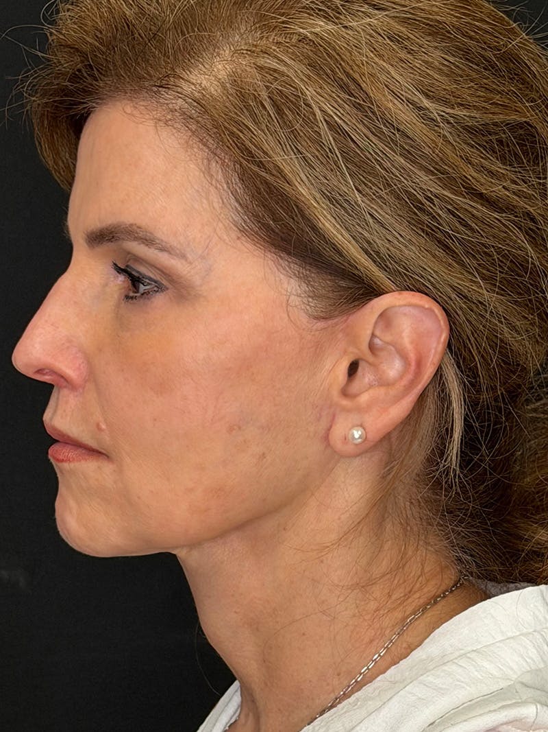 Deep Plane Facelift 60s Before & After Gallery - Patient 246083 - Image 10