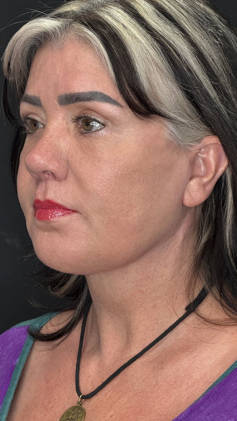 ContourLift Before & After Gallery - Patient 191038 - Image 10