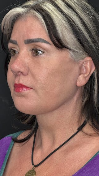 ContourLift Before & After Gallery - Patient 191038 - Image 10