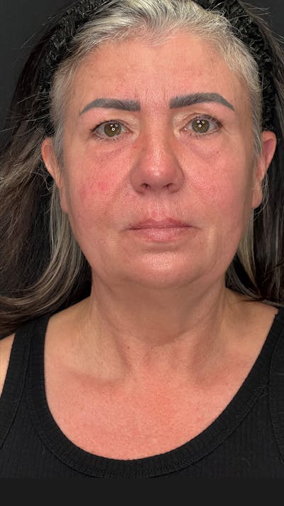 Deep Plane Facelift 50s Before & After Gallery - Patient 353690 - Image 1