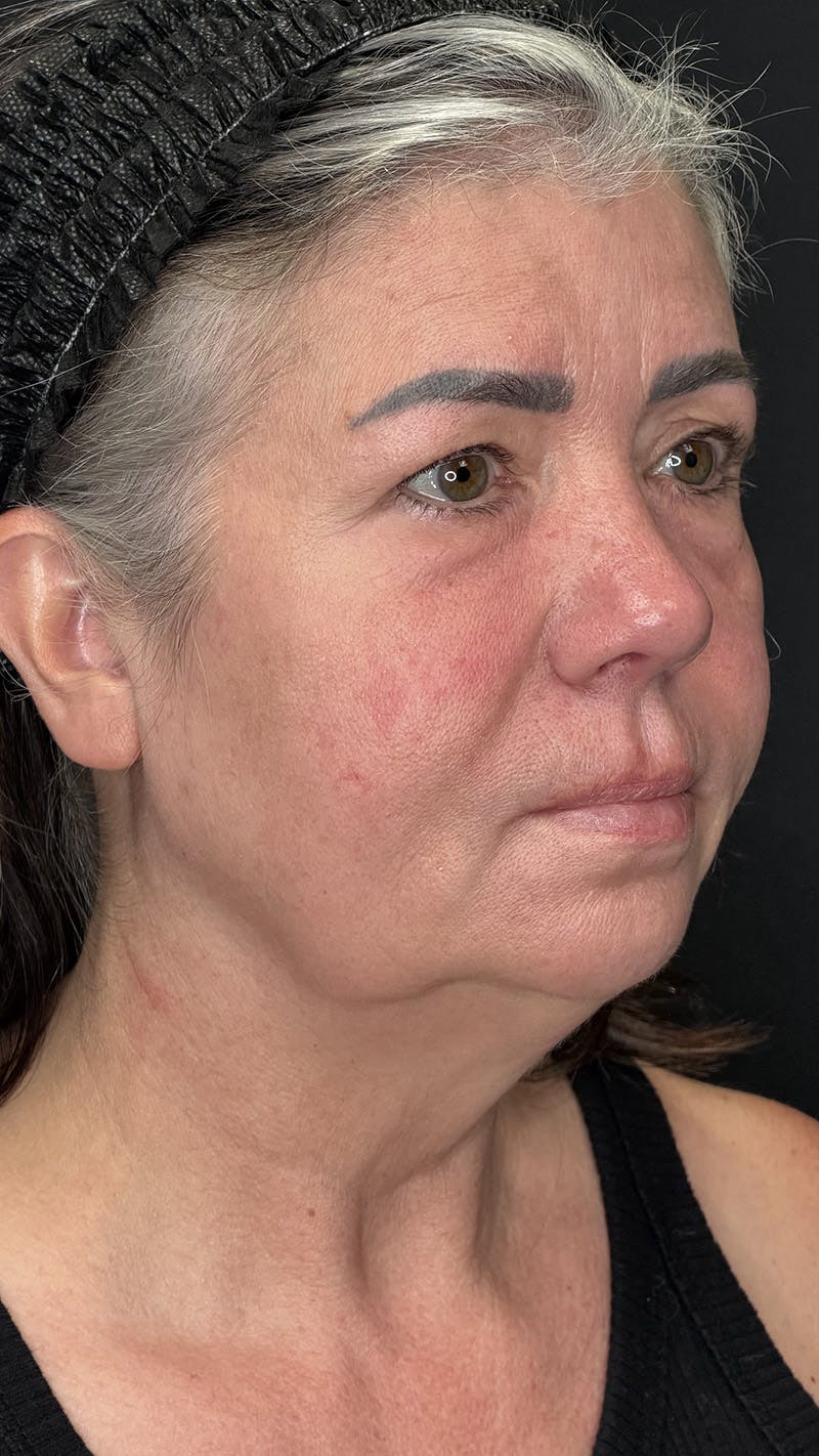 ContourLift Before & After Gallery - Patient 191038 - Image 3