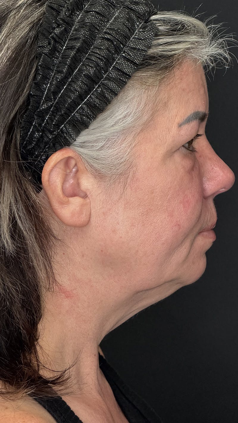 ContourLift Before & After Gallery - Patient 191038 - Image 5