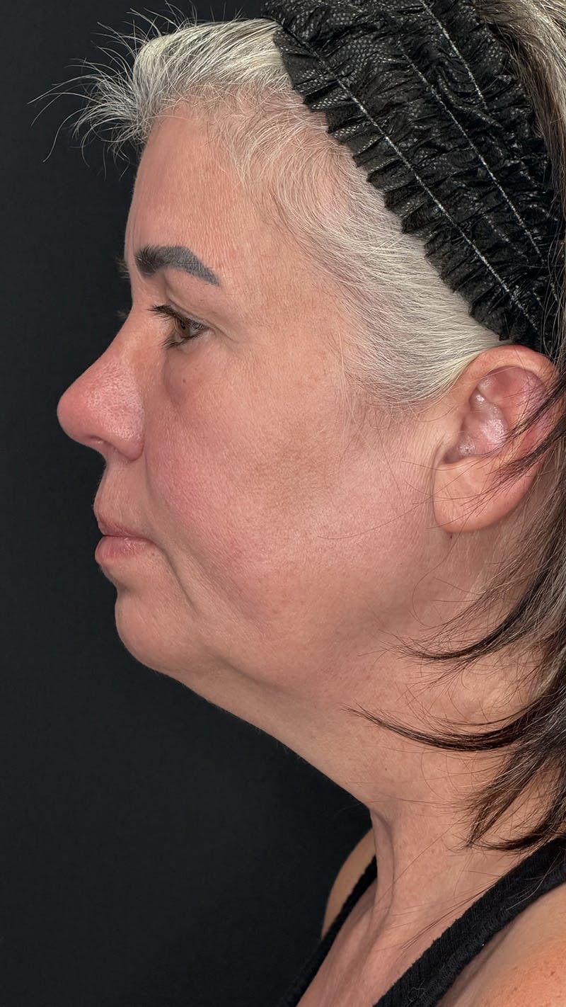 ContourLift Before & After Gallery - Patient 191038 - Image 11