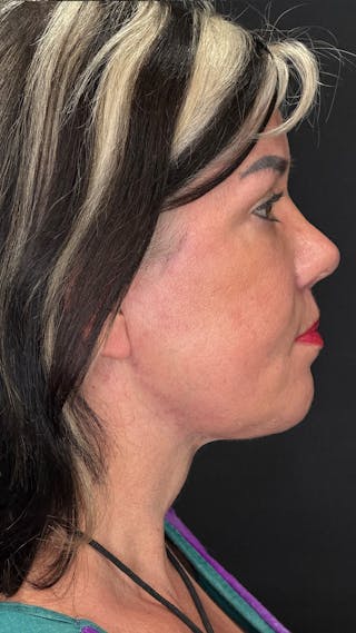 ContourLift Before & After Gallery - Patient 191038 - Image 6