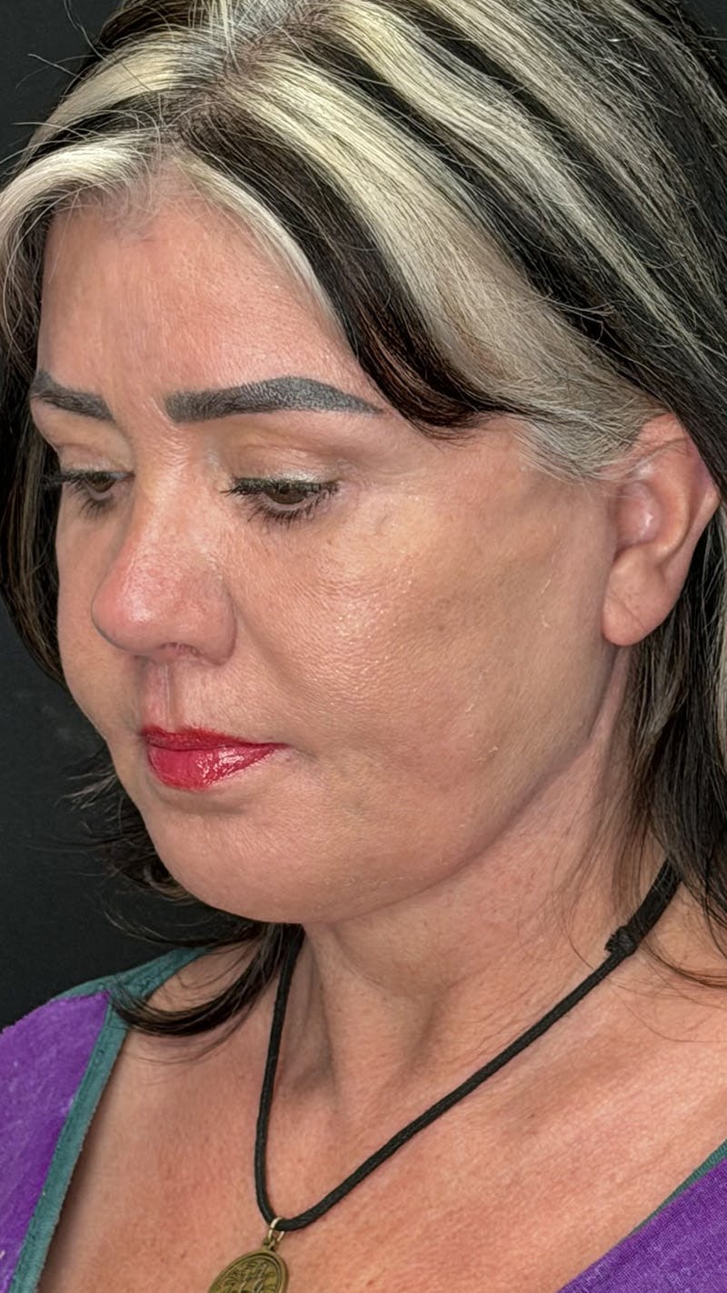 ContourLift Before & After Gallery - Patient 191038 - Image 7
