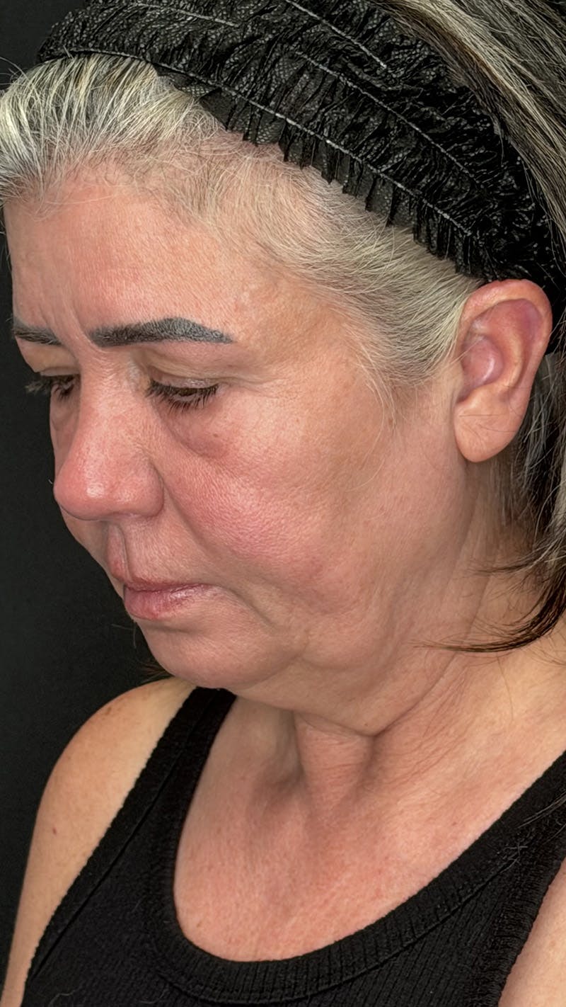 ContourLift Before & After Gallery - Patient 191038 - Image 8