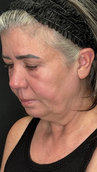 ContourLift Before & After Gallery - Patient 191038 - Image 8