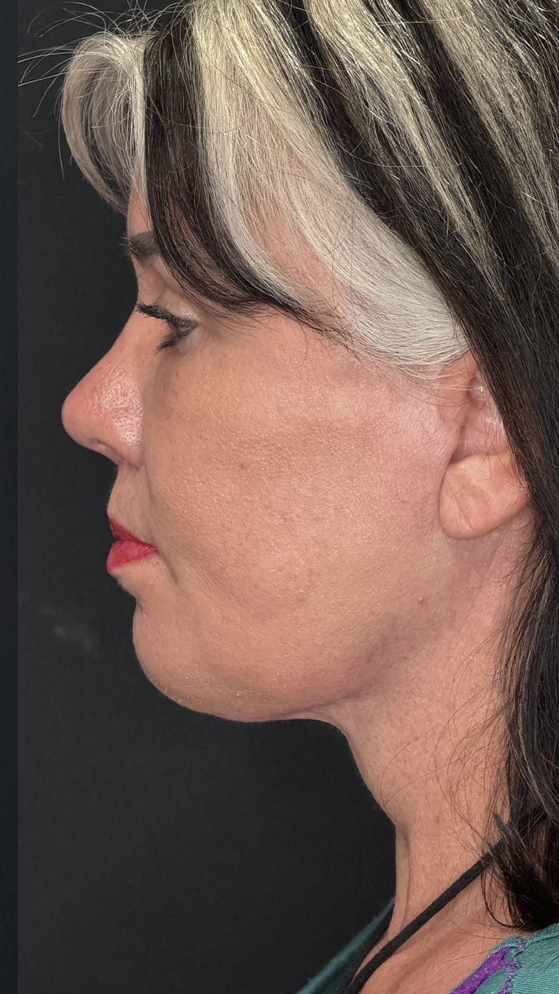 ContourLift Before & After Gallery - Patient 191038 - Image 12