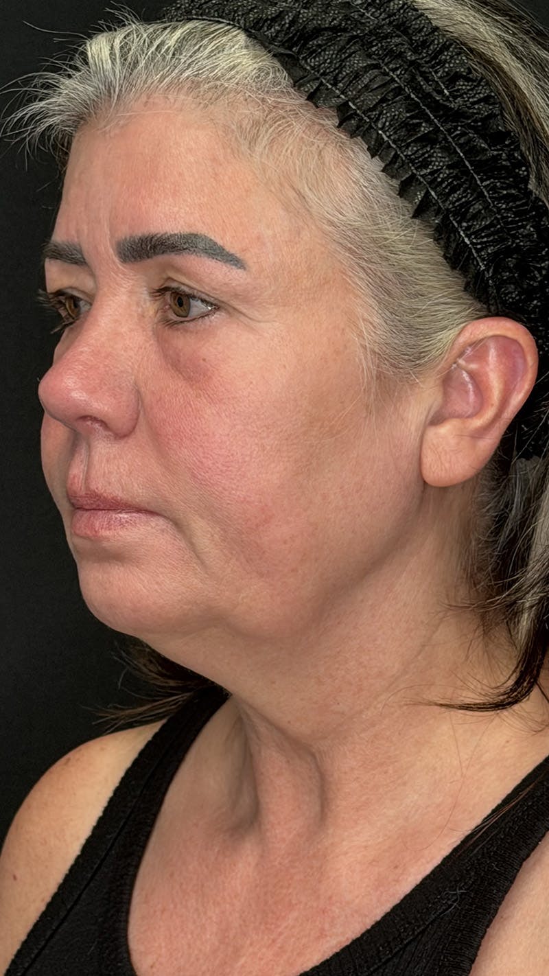 ContourLift Before & After Gallery - Patient 191038 - Image 9