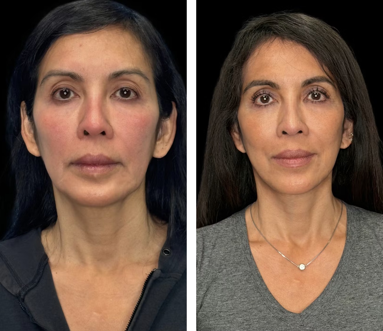 Before and After