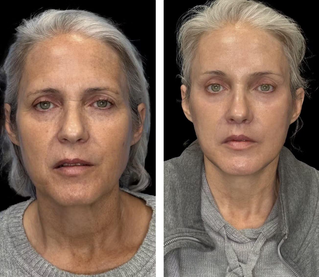 Before and After