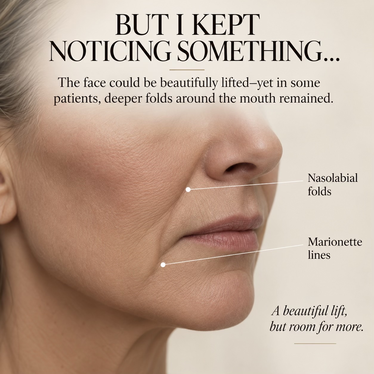 Close-up of nasolabial folds and marionette lines around a woman’s mouth