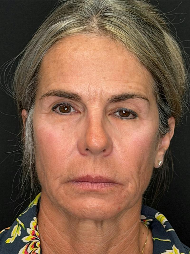 Deep Plane Facelift 50s Before & After Gallery - Patient 345251 - Image 1
