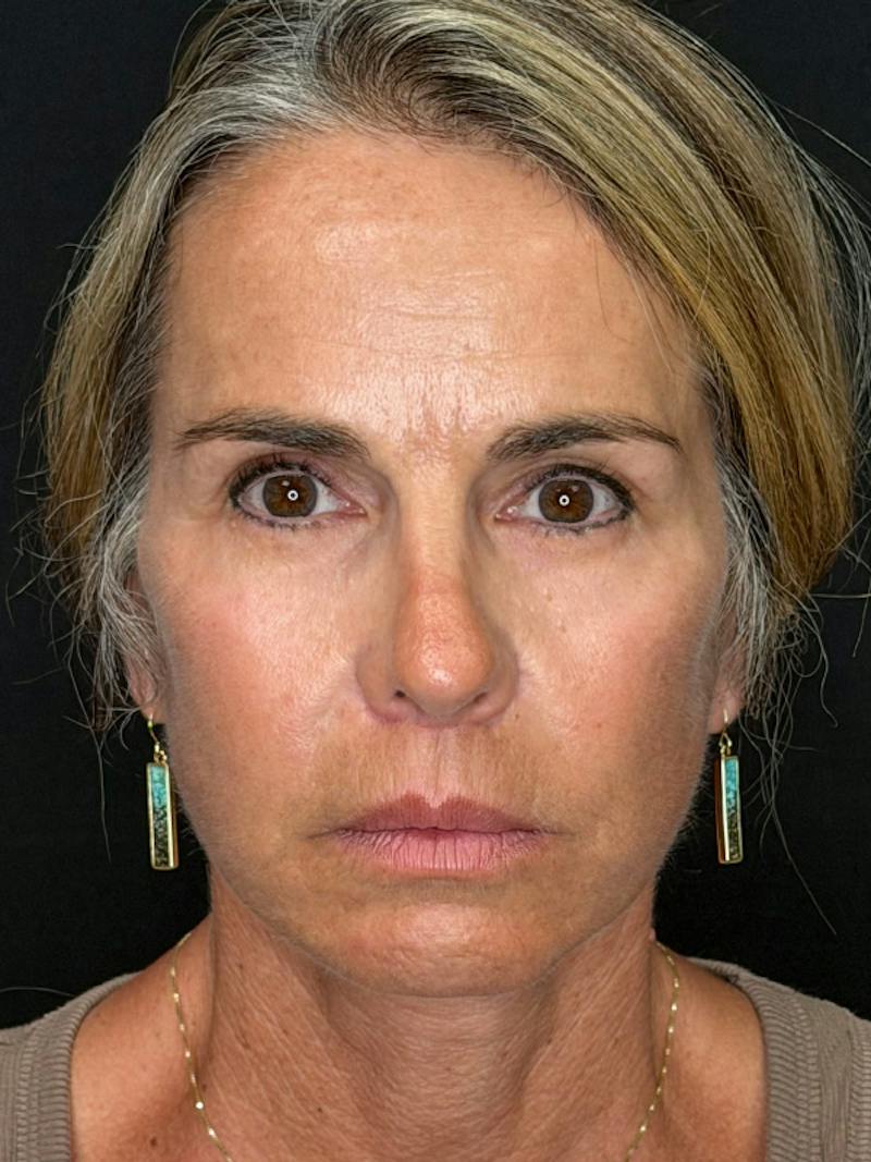 Deep Plane Facelift 50s Before & After Gallery - Patient 345251 - Image 2