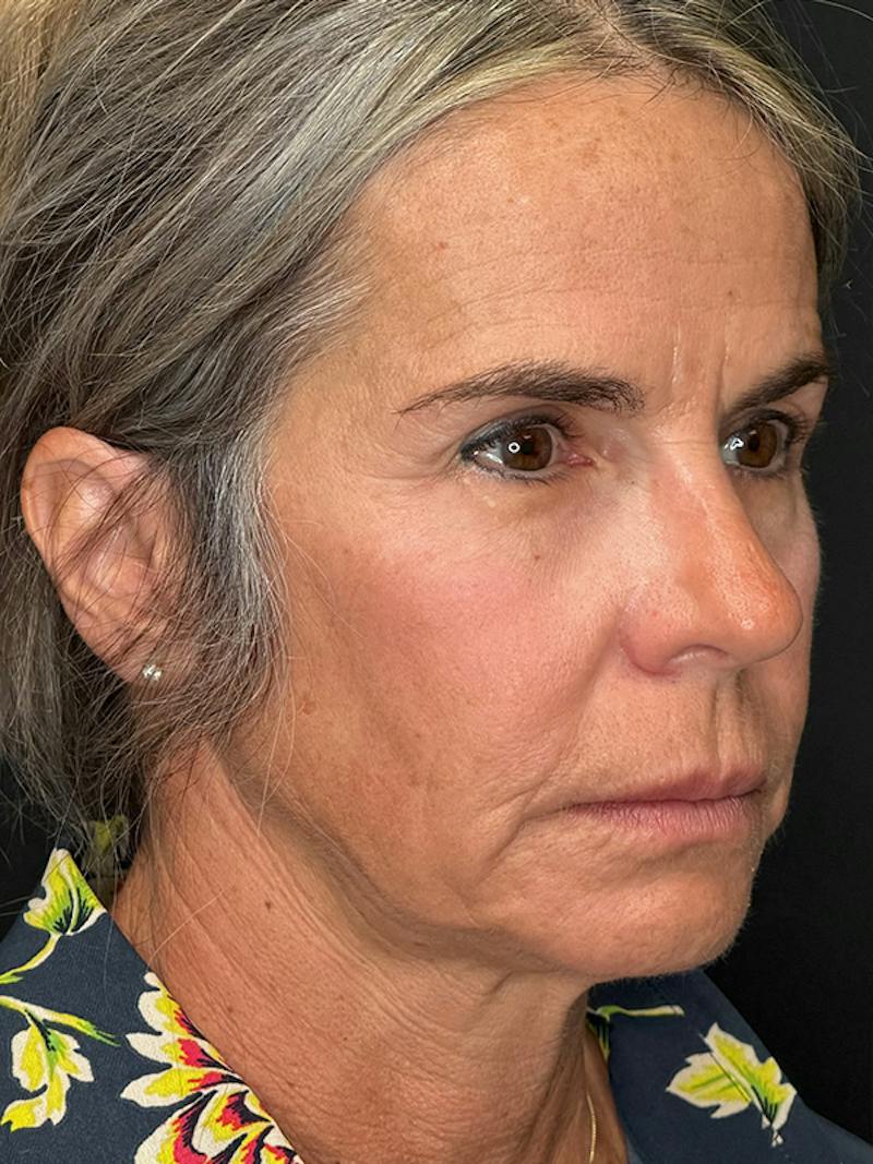 Deep Plane Facelift 50s Before & After Gallery - Patient 345251 - Image 3