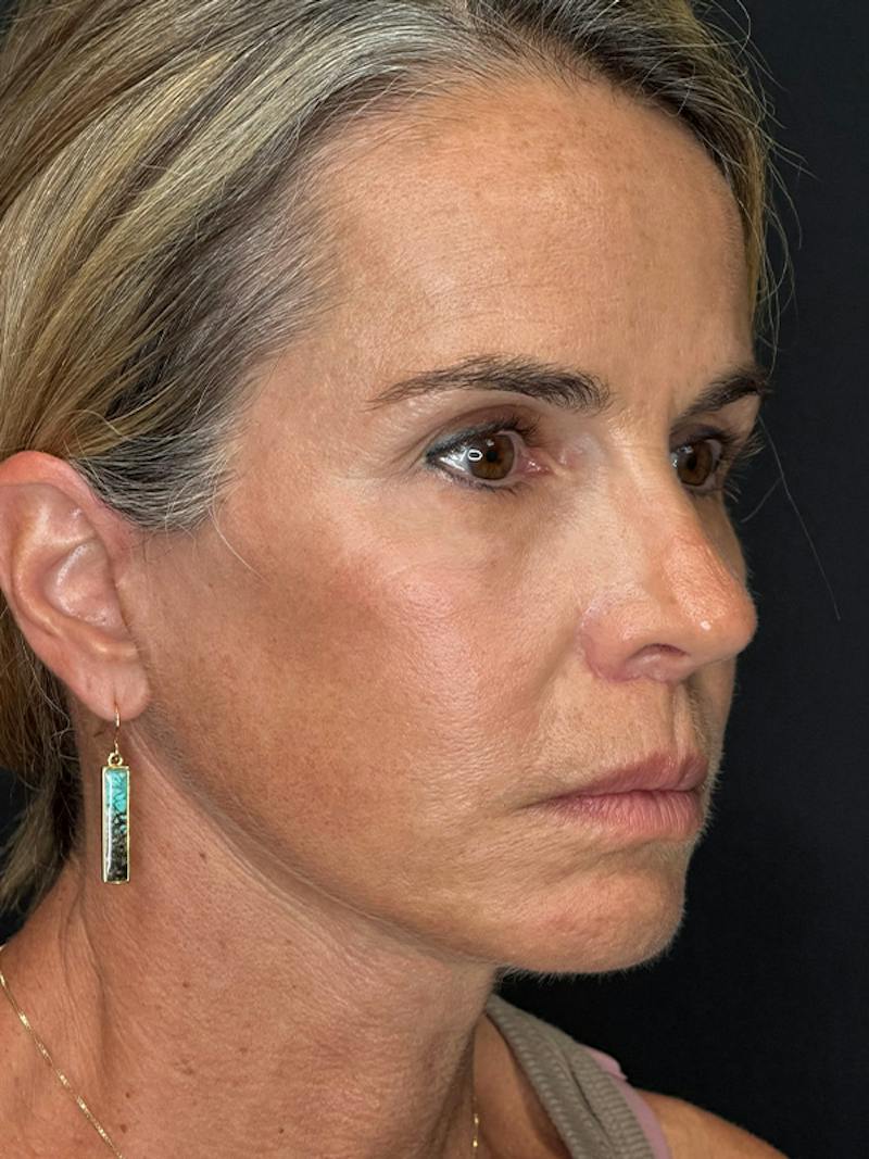 Deep Plane Facelift 50s Before & After Gallery - Patient 345251 - Image 4