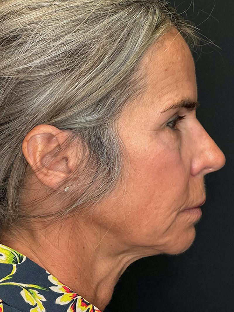 Deep Plane Facelift 50s Before & After Gallery - Patient 345251 - Image 7