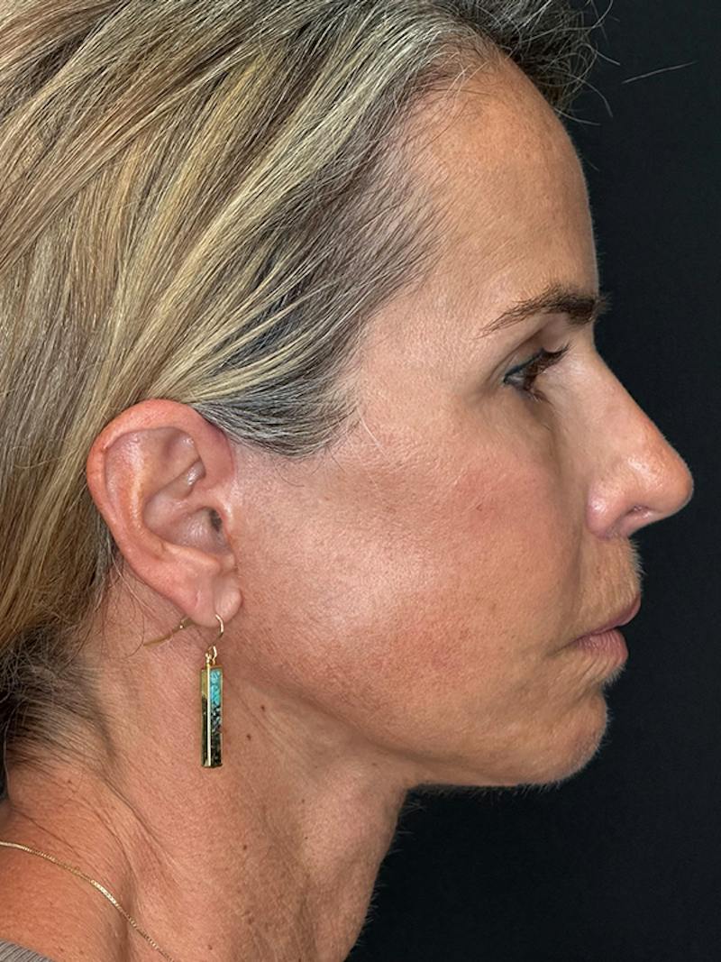 Deep Plane Facelift 50s Before & After Gallery - Patient 345251 - Image 8