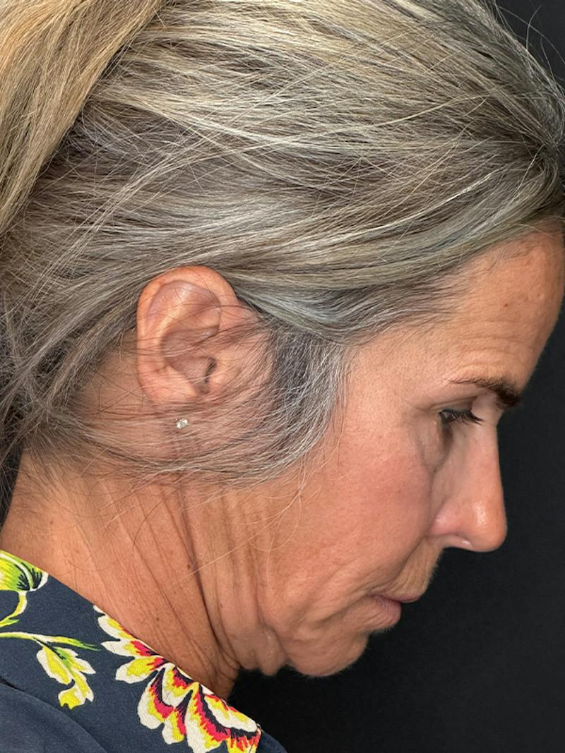 Deep Plane Facelift 50s Before & After Gallery - Patient 345251 - Image 9