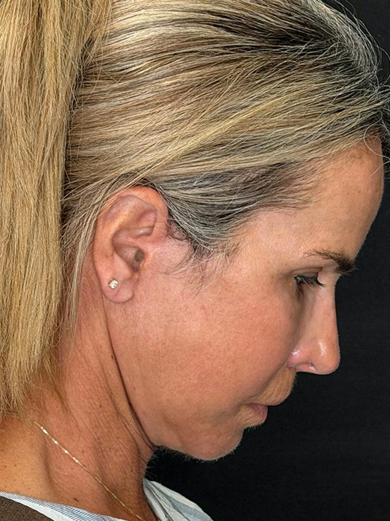 Deep Plane Facelift 50s Before & After Gallery - Patient 345251 - Image 10
