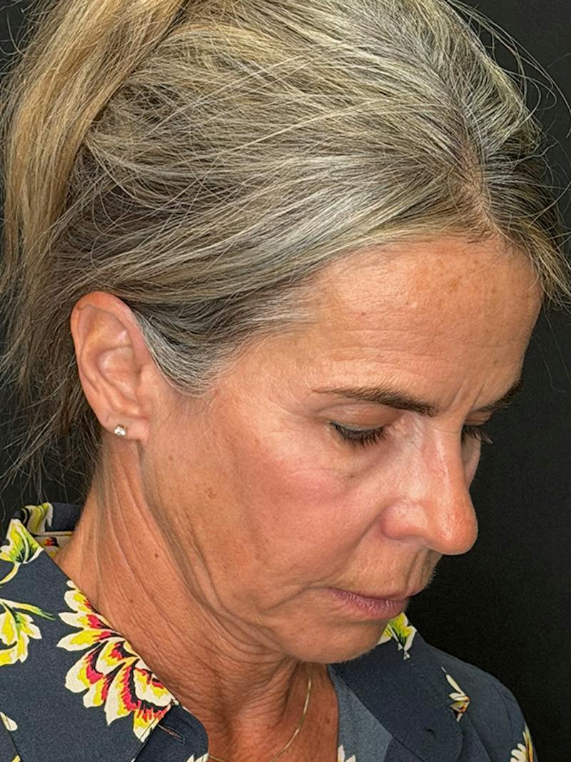 Deep Plane Facelift 50s Before & After Gallery - Patient 345251 - Image 5