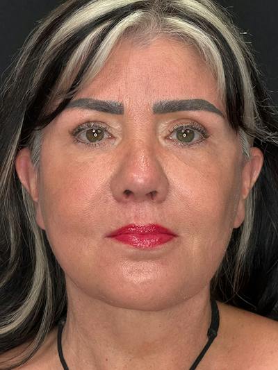 Deep Plane Facelift 50s Before & After Gallery - Patient 353690 - Image 2