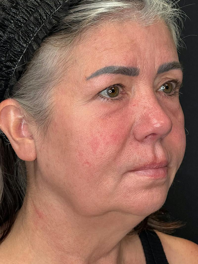 ContourLift Before & After Gallery - Patient 191038 - Image 3