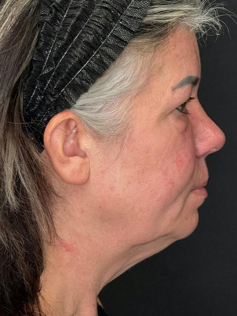 ContourLift Before & After Gallery - Patient 191038 - Image 5