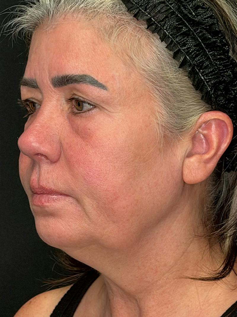 ContourLift Before & After Gallery - Patient 191038 - Image 7