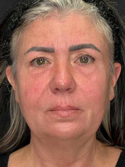ContourLift Before & After Gallery - Patient 191038 - Image 1