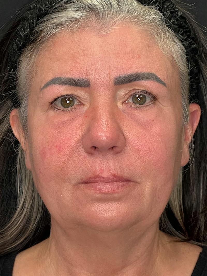 ContourLift Before & After Gallery - Patient 191038 - Image 1