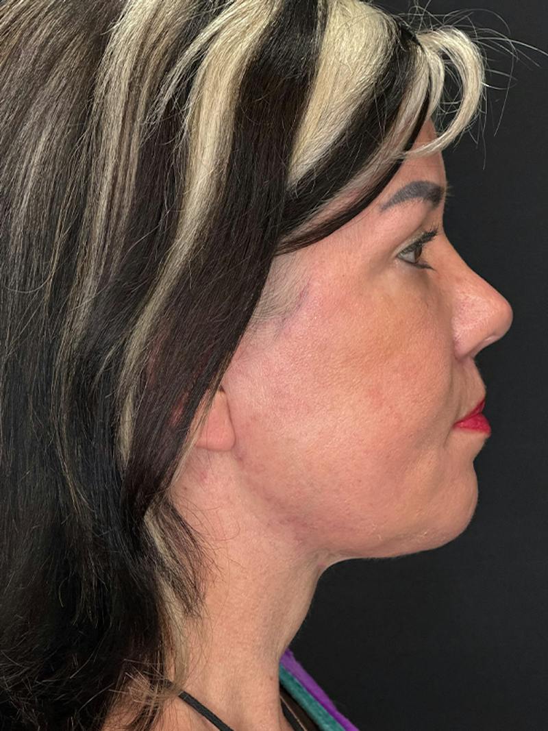 ContourLift Before & After Gallery - Patient 191038 - Image 6