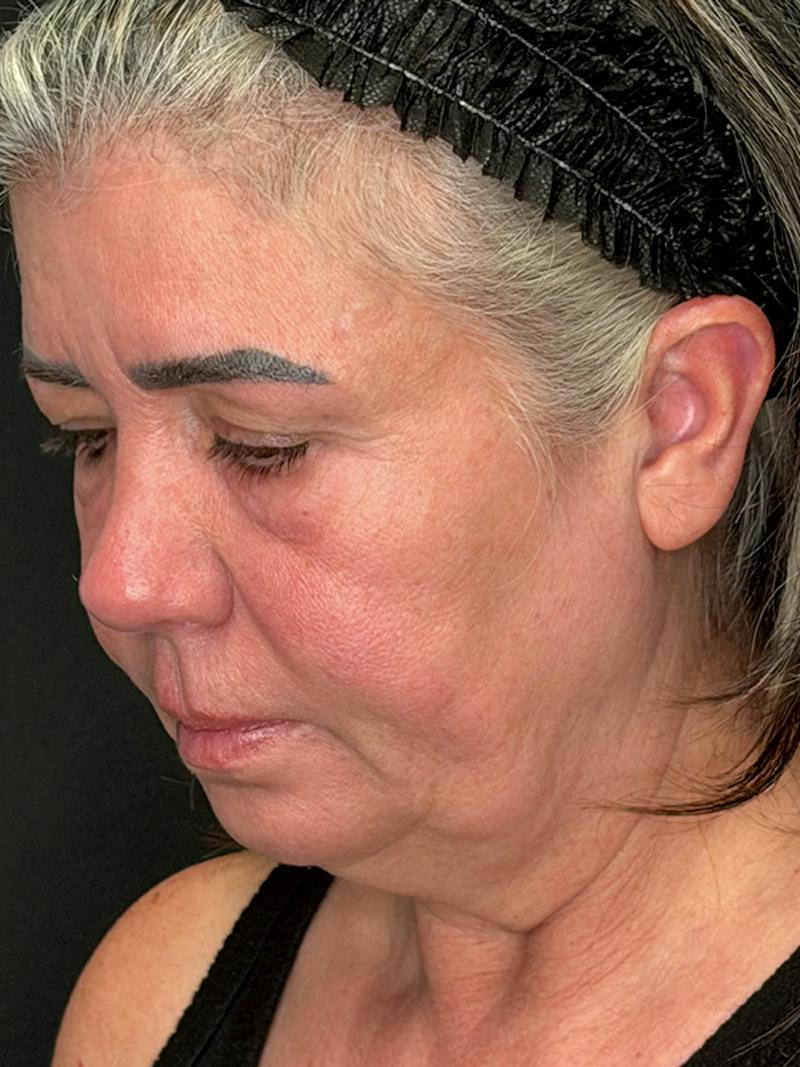 ContourLift Before & After Gallery - Patient 191038 - Image 9