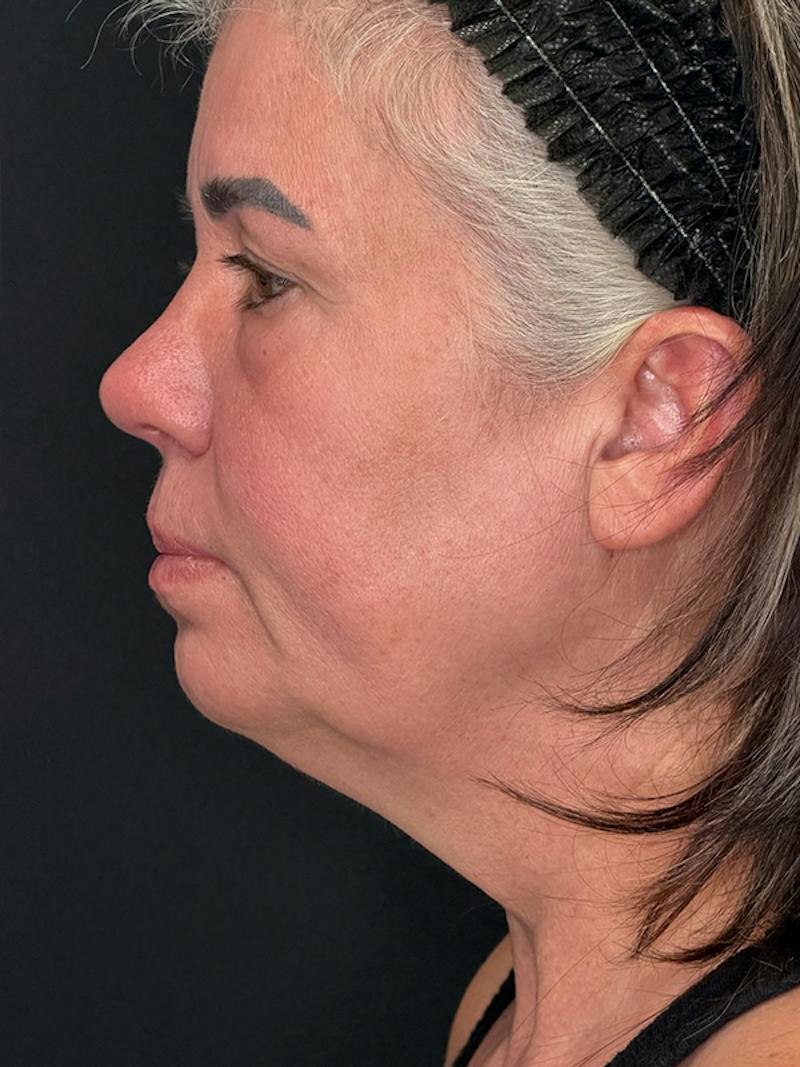 ContourLift Before & After Gallery - Patient 191038 - Image 11