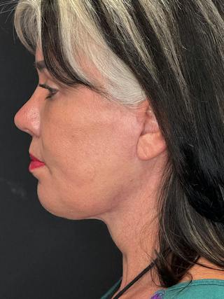 ContourLift Before & After Gallery - Patient 191038 - Image 12