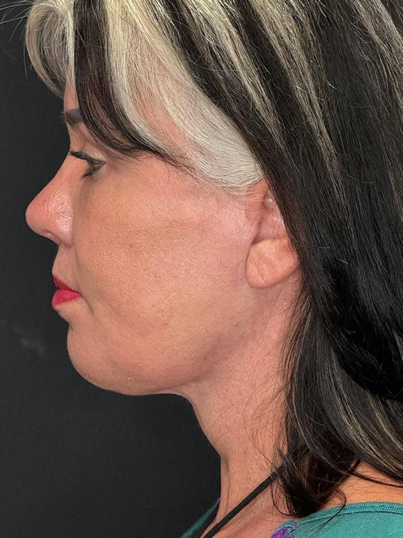 ContourLift Before & After Gallery - Patient 191038 - Image 12