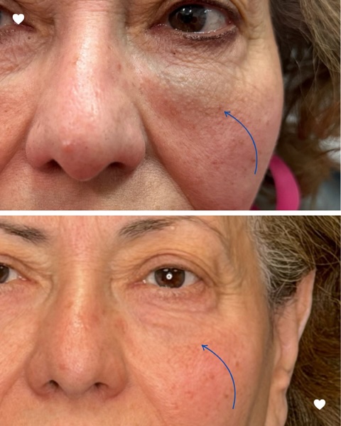 Before-and-after photos showing improvement in under-eye filler irregularities after dissolving filler.