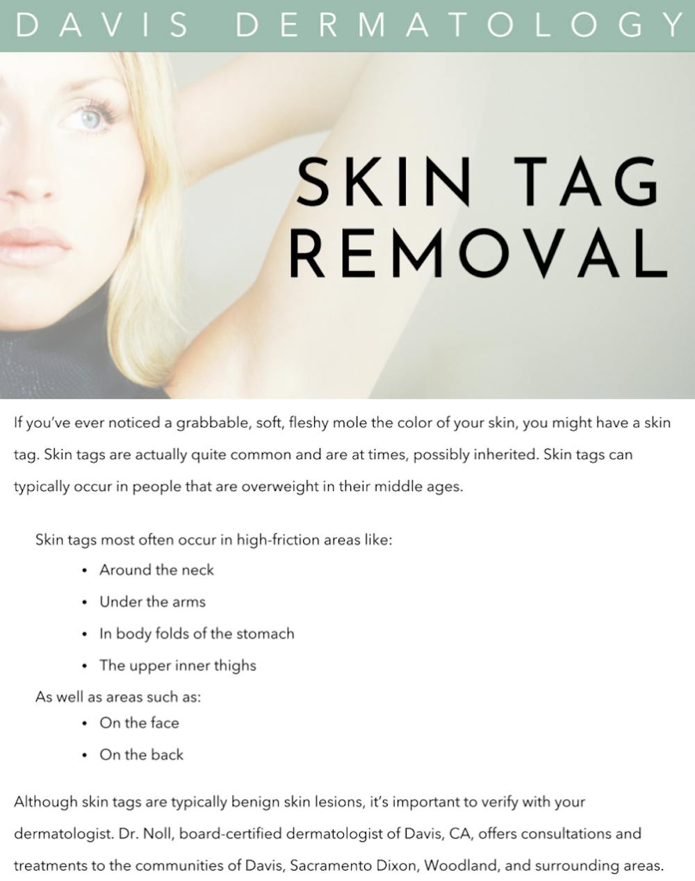 skin tag removal infographic