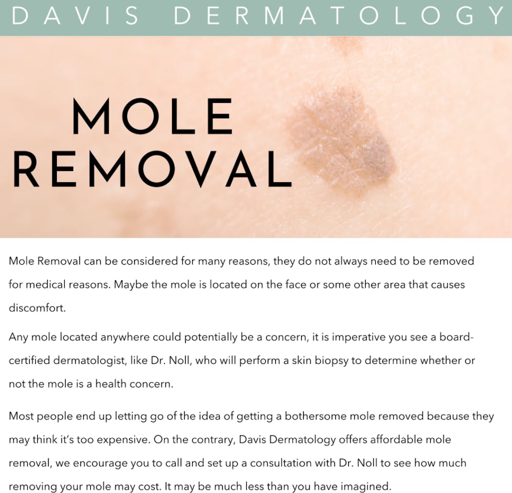 mole removal infographic