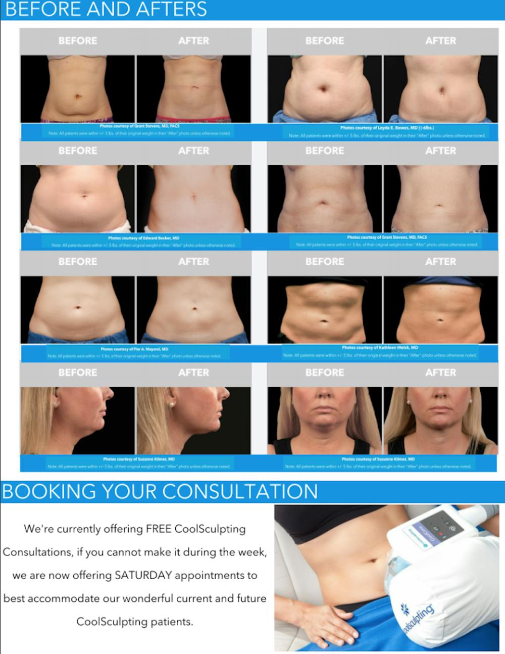 coolsculpting infographic