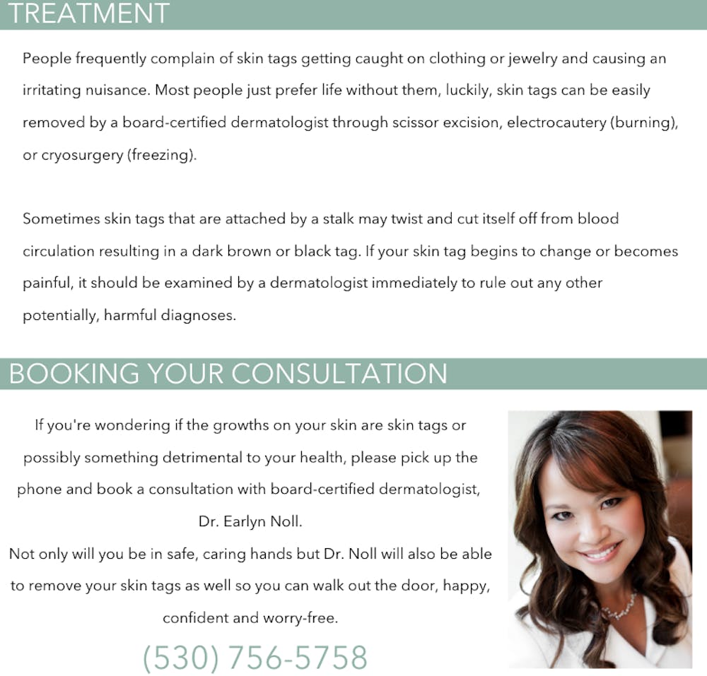 skin tag removal infographic