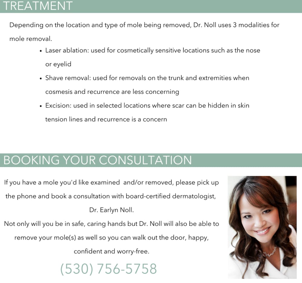 mole removal infographic