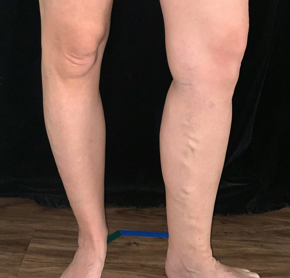 Sclerotherapy Before & After Gallery - Patient 188145 - Image 1