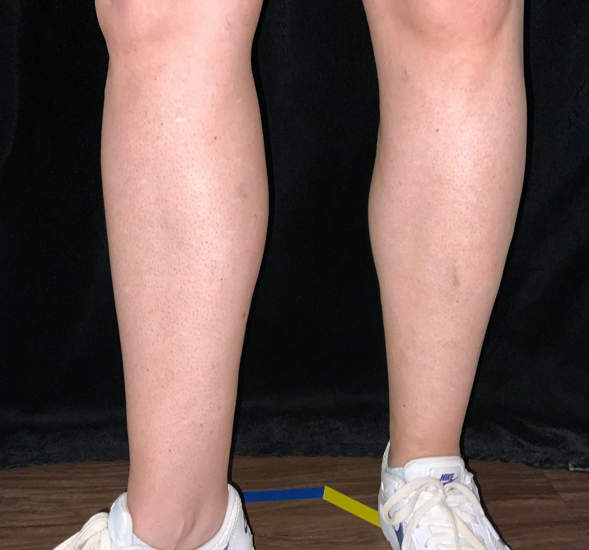 Sclerotherapy Before & After Gallery - Patient 188145 - Image 4