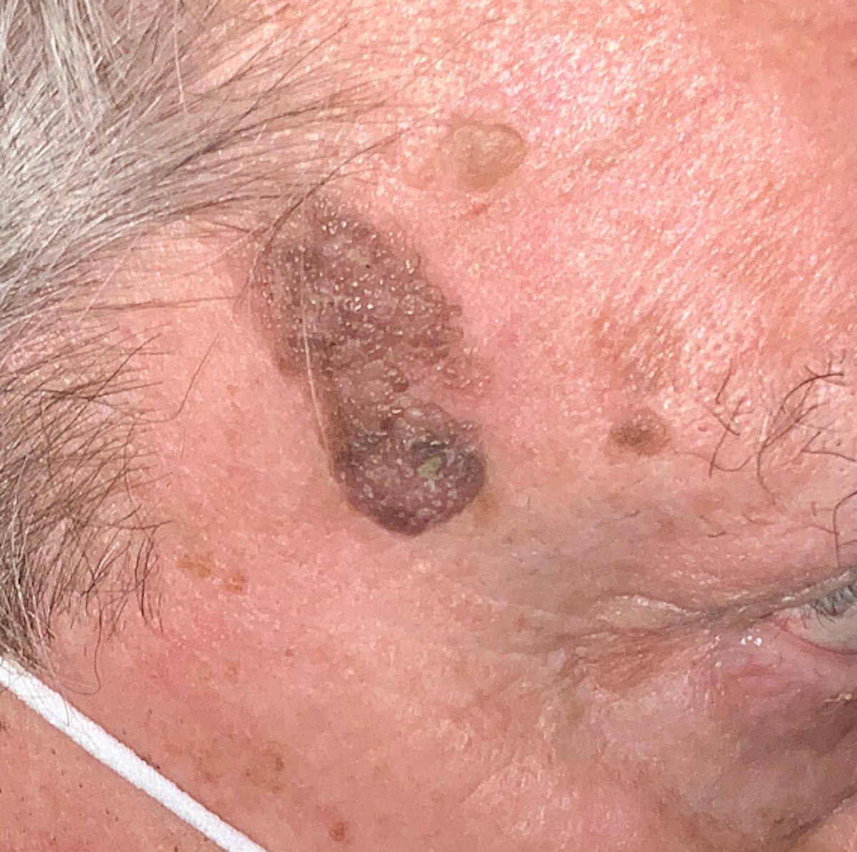 Shave Removal Before & After Gallery - Patient 645249 - Image 1