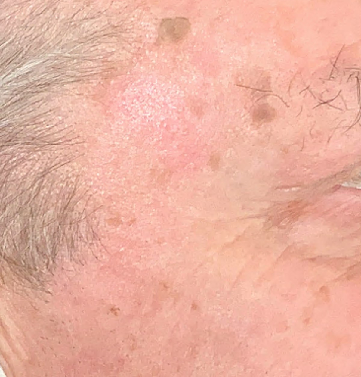 Shave Removal Before & After Gallery - Patient 645249 - Image 2