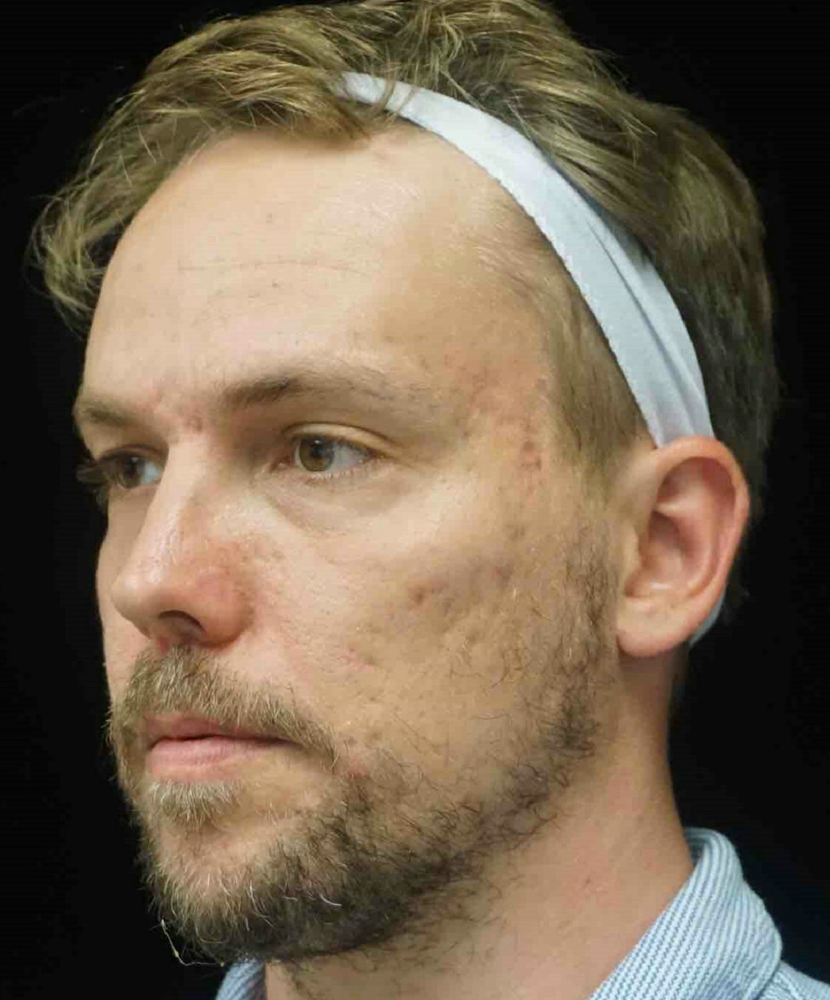 Subcision Before & After Gallery - Patient 181669 - Image 3