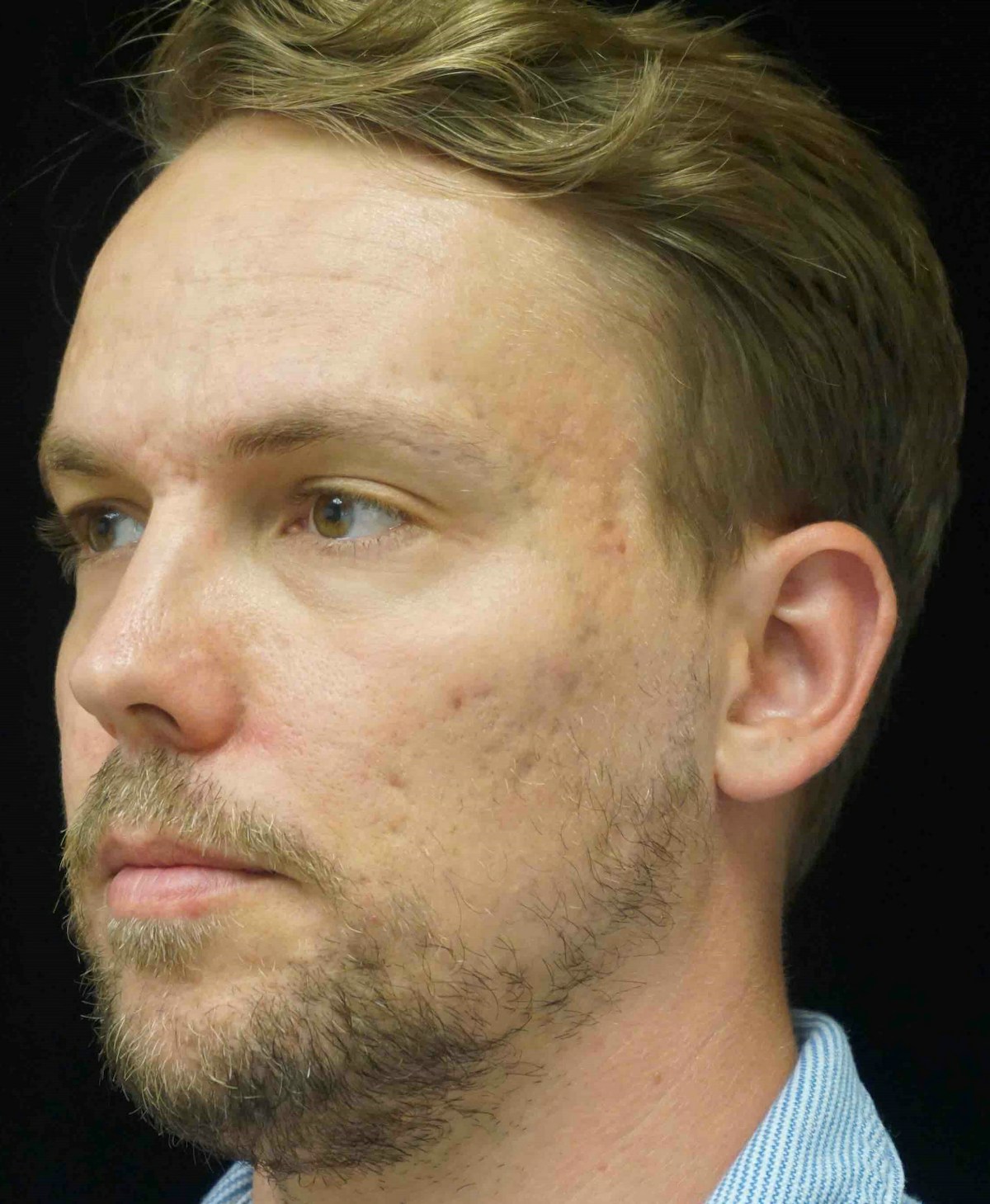 Subcision Before & After Gallery - Patient 181669 - Image 4